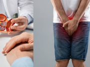 Factor oculto que impulsa el cáncer de próstata agresivo, según Mayo Clinic