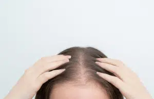 Alopecia femenina: la enfermedad silenciosa que muchas mujeres ocultan bajo pelucas y extensiones