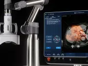 El sonido que destruye tumores: la técnica de ultrasonido focal revoluciona el tratamiento del cáncer sin cirugía