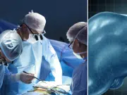 Médicos analizan el caso de paciente que sobrevivió 171 días con el hígado de un cerdo modificado genéticamente: ‘Un avance crucial’