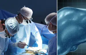 Médicos analizan el caso de paciente que sobrevivió 171 días con el hígado de un cerdo modificado genéticamente: ‘Un avance crucial’