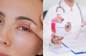 Oftalmólogos entregan recomendaciones para evitar y cuidar los orzuelos y explican por qué salen realmente: ‘Mantener una higiene adecuada’