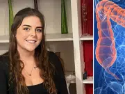 Adolescente de 19 años fue diagnosticada con cáncer de intestino en etapa 3 después de que los médicos lo descartaran 13 veces por ser muy joven