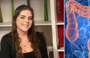 Adolescente de 19 años fue diagnosticada con cáncer de intestino en etapa 3 después de que los médicos lo descartaran 13 veces por ser muy joven