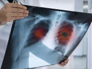 El cáncer de pulmón sigue siendo el más letal del mundo: 1,8 millones de muertes anuales y riesgo creciente en América Latina