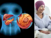 Cáncer de páncreas: FDA concede vía rápida a medicamento experimental tras prometedores resultados iniciales