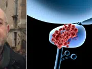Revelación de urólogo sobre el cáncer de próstata: ‘El 80 % de los pacientes van a poder curarse’