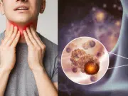 Aumento mundial de cáncer de tiroides: ¿a que se debe el creciente número de casos? La ciencia responde