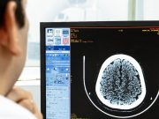 Colombia duplica la atención oportuna del accidente cerebrovascular pese al déficit de especialistas