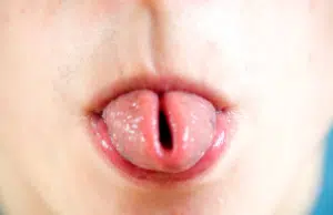 ¿Usted puede doblar la lengua en U? Genetistas descubren por qué algunas personas no