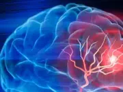 Así afecta un accidente cerebrovascular al lenguaje: el cerebro escucha, pero no entiende