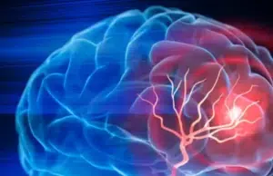 Así afecta un accidente cerebrovascular al lenguaje: el cerebro escucha, pero no entiende