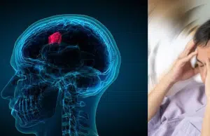 Seis síntomas que pueden indicar un tumor cerebral y que muchos pasan por alto