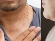 ¿Qué pasa si elimina las verrugas del cuerpo con un cabello o un hilo? Esto dicen los expertos.