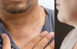¿Qué pasa si elimina las verrugas del cuerpo con un cabello o un hilo? Esto dicen los expertos.