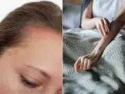 Psoriasis: la enfermedad que equivocadamente muchos tildan de ‘nerviosa’ y que afecta más que la piel