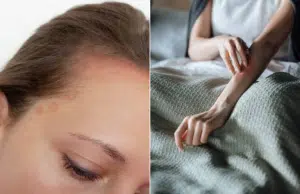 Psoriasis: la enfermedad que equivocadamente muchos tildan de ‘nerviosa’ y que afecta más que la piel