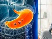 ¿Cuáles son los primeros síntomas del cáncer de estómago, según la Clínica Mayo?