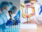 Vacuna experimental muestra resultados prometedores para prevenir el cáncer de colon en pacientes de alto riesgo