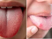 ¿Por qué aparecen puntos rojos en la lengua? Lo que puede indicar sobre la salud