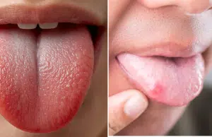 ¿Por qué aparecen puntos rojos en la lengua? Lo que puede indicar sobre la salud
