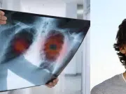 Logran que hombre viviera sin pulmones durante 48 horas en medio de trasplante: hito médico