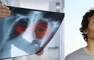 Logran que hombre viviera sin pulmones durante 48 horas en medio de trasplante: hito médico