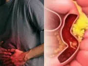 Test FIT, colonoscopia y cáncer de colon: estudio revela gran beneficio contra casos graves