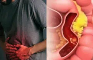 Test FIT, colonoscopia y cáncer de colon: estudio revela gran beneficio contra casos graves