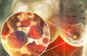 Medicina personalizada permite predecir metástasis y definir qué pacientes con cáncer de mama requieren quimioterapia