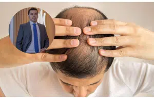 ‘La alopecia androgenética no tiene cura y no existen terapias mágicas con resultados inmediatos’: advierte experto