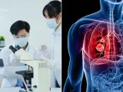 Nuevo sensor óptico permite la detección temprana del cáncer de pulmón con un simple análisis de sangre: anticipa el tumor antes de ser visible