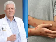 ¿Cuáles son los síntomas del sarampión en adultos y por qué pueden ser más graves que en niños? Doctor Alejandro Macías lo explica