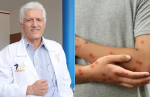 ¿Cuáles son los síntomas del sarampión en adultos y por qué pueden ser más graves que en niños? Doctor Alejandro Macías lo explica