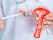 Cáncer de cuello uterino sigue siendo el segundo más frecuente en mujeres en Colombia: puede prevenirse y tratarse con éxito si se actúa a tiempo