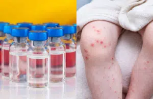 ¿Cómo saber si ya tiene la dosis indicada de la vacuna contra el sarampión en Colombia? Estas son las recomendaciones del Ministerio de Salud