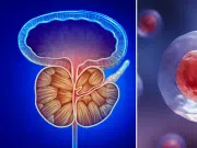 Así es la prueba que hace ‘brillar’ las células del cáncer de próstata y podría reducir a la mitad las biopsias, según estudio pionero