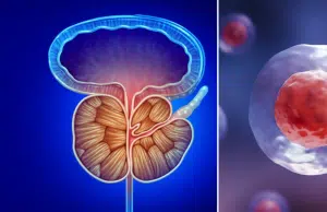 Así es la prueba que hace ‘brillar’ las células del cáncer de próstata y podría reducir a la mitad las biopsias, según estudio pionero