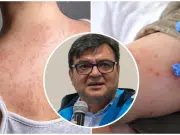 Secretario Distrital de Salud, Gerson Bermont, aseguró que hay una ‘disponibilidad muy limitada’ de vacunas contra el sarampión en Bogotá