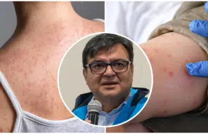 Secretario Distrital de Salud, Gerson Bermont, aseguró que hay una ‘disponibilidad muy limitada’ de vacunas contra el sarampión en Bogotá