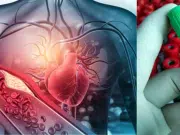 Cambian las guías de nivel del colesterol y los límites para evitar infartos y derrames cerebrales