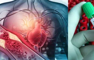 Cambian las guías de nivel del colesterol y los límites para evitar infartos y derrames cerebrales