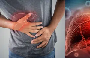 Estos son los síntomas tempranos de la cirrosis hepática, según la Clínica Mayo