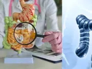 Cáncer de colon aumenta en adultos jóvenes menores de 50: los médicos ya saben por qué está pasando esto