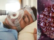 Jefe de neumología advierte que pacientes con apnea obstructiva del sueño enfrentan mayor riesgo de cáncer y muerte: ‘Fallan ante células tumorales’