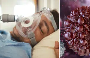Jefe de neumología advierte que pacientes con apnea obstructiva del sueño enfrentan mayor riesgo de cáncer y muerte: ‘Fallan ante células tumorales’