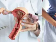 Tres señales del cáncer de cuello uterino que se pasan por alto