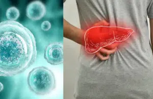 Investigadores de la Clínica Mayo identifican ‘células zombi’ responsables de inflamación en hígado graso