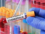 Solo 6 de cada 10 pacientes con hemofilia reciben atención integral en Colombia: diagnóstico temprano es clave para mejorar vida de quienes la padecen