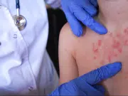 Alerta en Colombia por riesgo de aumento de sarampión: expertos y autoridades insisten en reforzar vacunación para evitar brotes